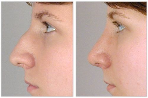 rhinoplastie medicale tunisie