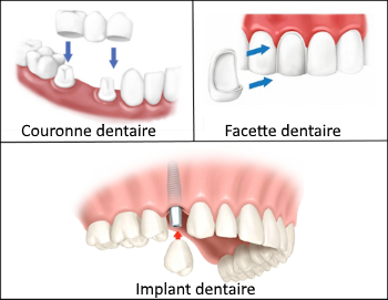 Quelle est la différence entre facette dentaire et couronne porcelaine ?