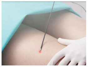 liposuccion laser tunisie