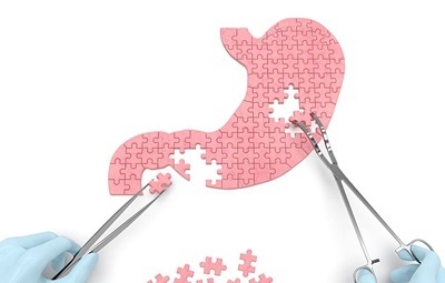 lestomac peut il regrossir apres un bypass