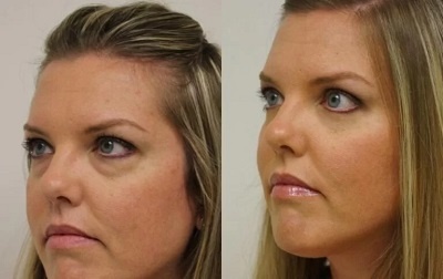 se maquiller apres un lifting visage
