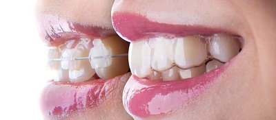 prix d'un Invisalign en Tunisie