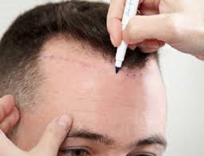 prix d'une greffe de cheveux