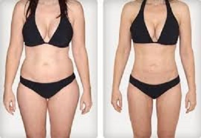 prix d'une liposuccion