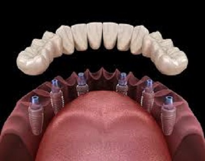 prix des implants All on 6
