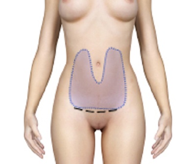 prix mini abdominoplastie tunisie