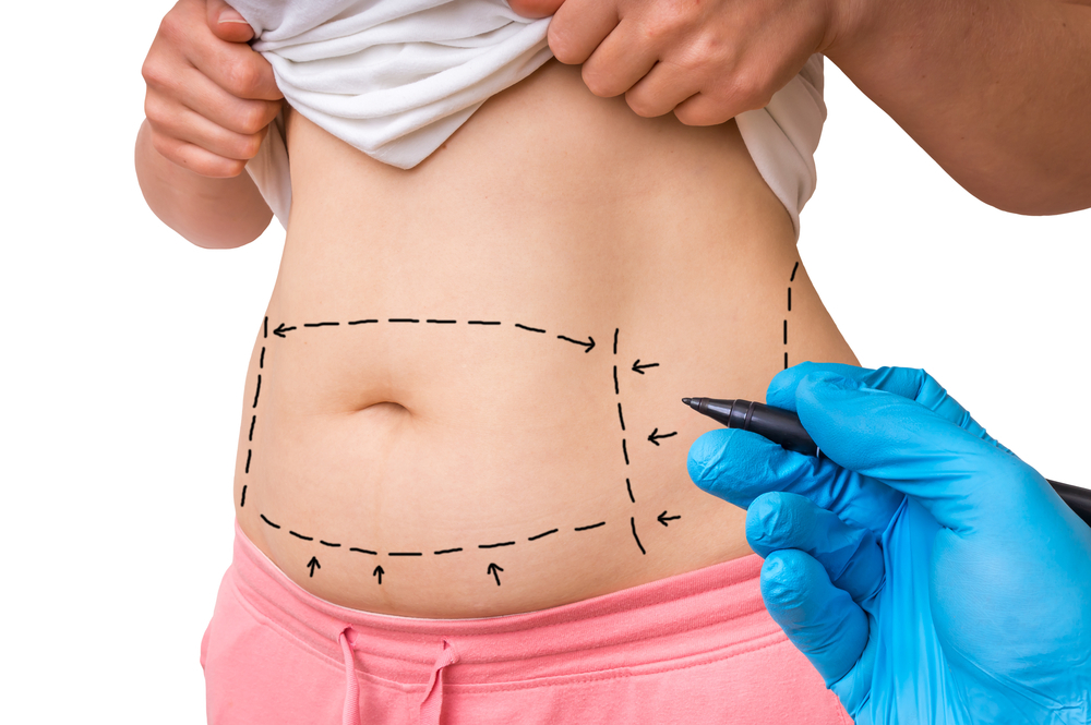 Tarifs chirurgie esthétique de l’abdominoplastie en Turquie : Guide & Informations complètes