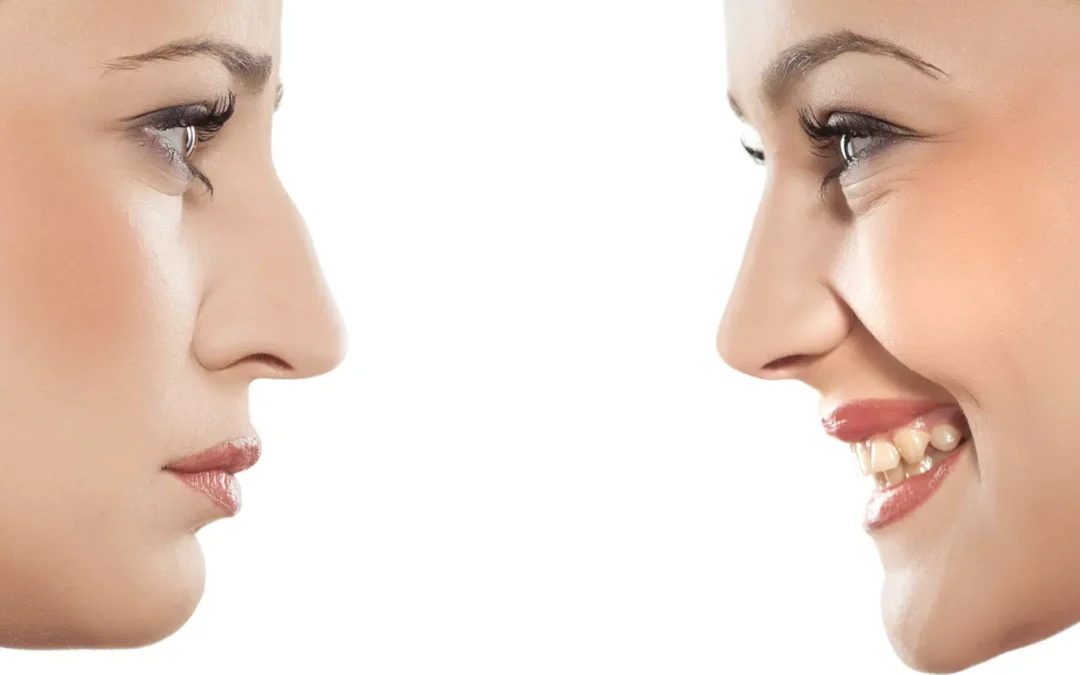 Tarifs chirurgie esthétique rhinoplastie Turquie