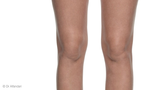Chirurgie esthétique Tunisie liposuccion des genoux : Tout ce que vous devez savoir