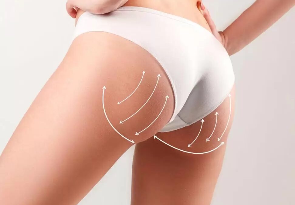 Chirurgie esthétique Tunisie réduction des fesses : Guide complet