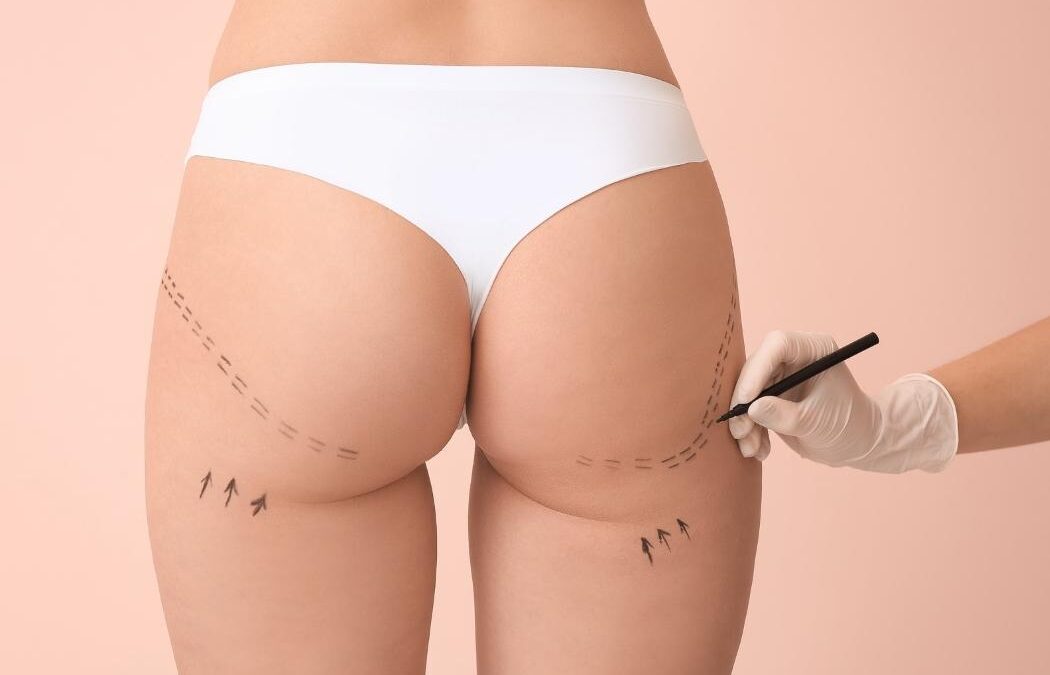Chirurgie esthétique Turquie BBL : Tout ce que vous devez savoir