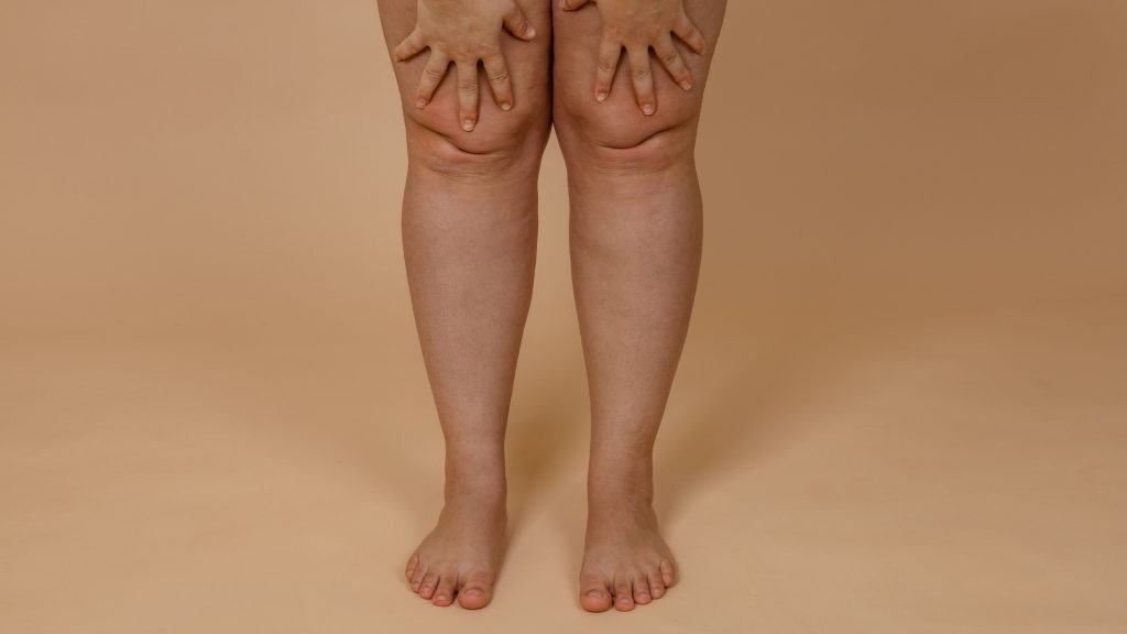 Chirurgie esthétique liposuccion genoux Tunisie tout compris