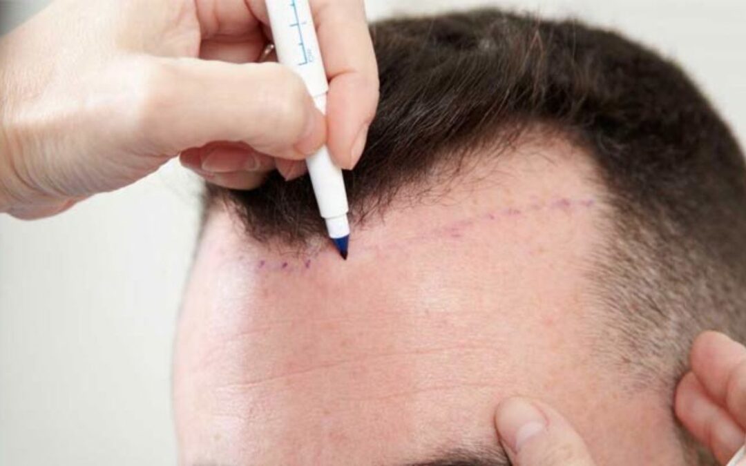 Greffe cheveux synthétique Biofibre Tunisie : Prix & Guide complet
