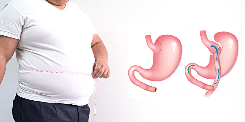 Combien de temps dure une opération d’un bypass gastrique ?
