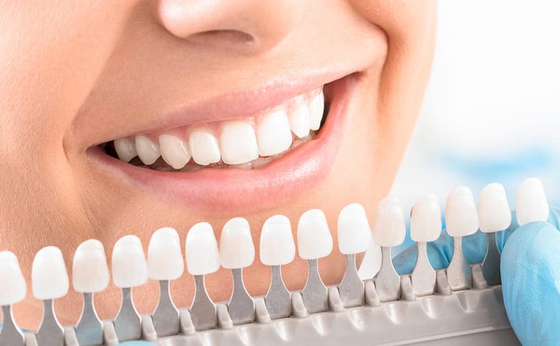 Est-il possible de faire une facette dentaire sur une seule dent ?