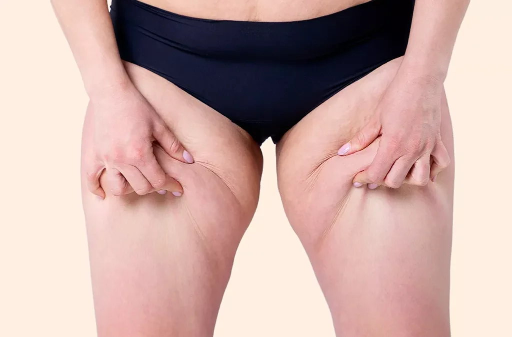 Quelle est la meilleure technique de liposuccion pour le lipœdème ?