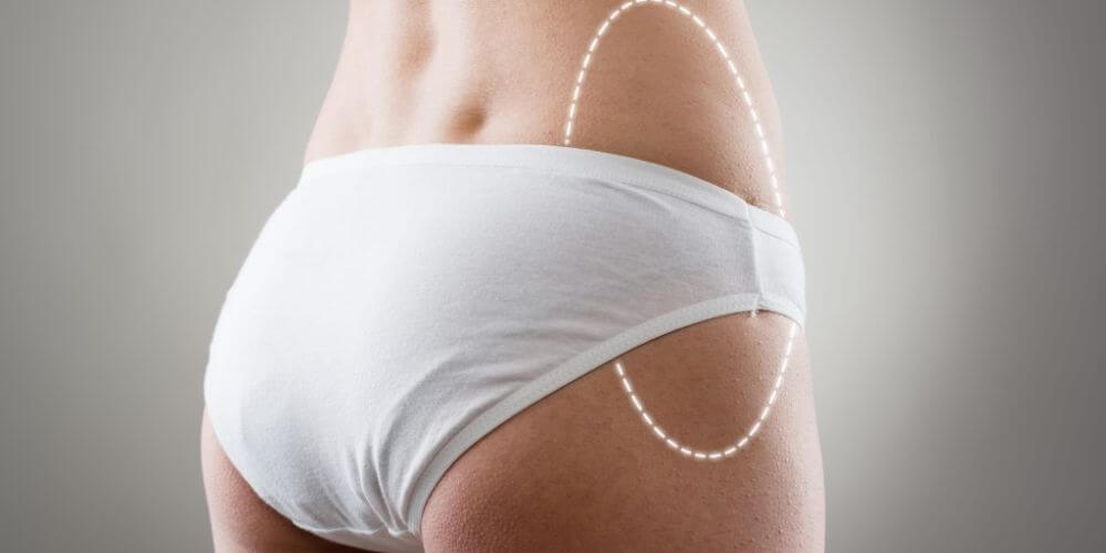Est-il possible d’élargir les hanches par la chirurgie ?