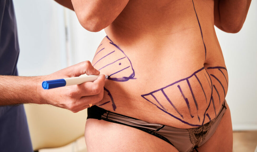 Combien de litres de graisse peut-on retirer au maximum avec une liposuccion ?