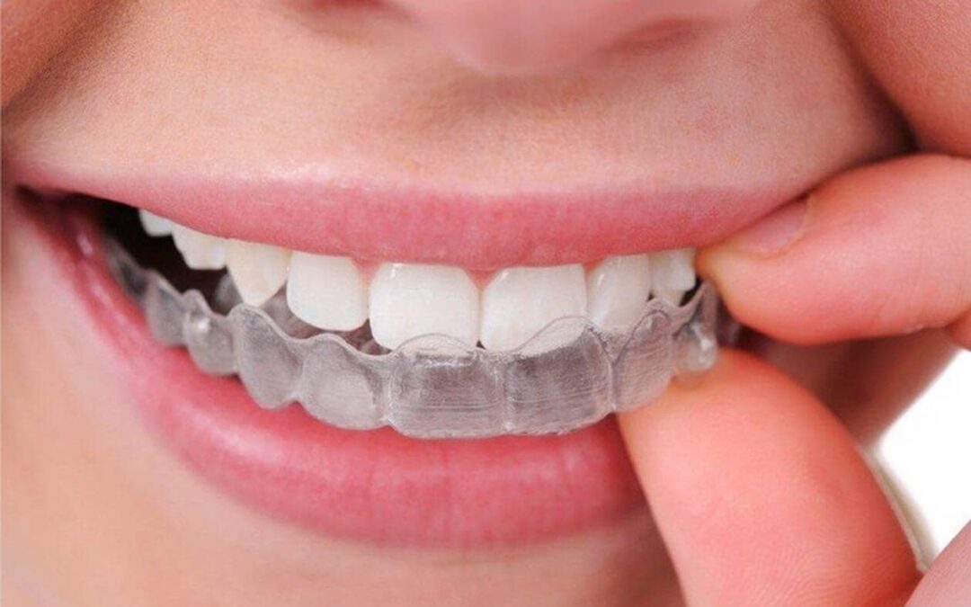 Combien de temps dure une extraction dentaire et une greffe osseuse ?
