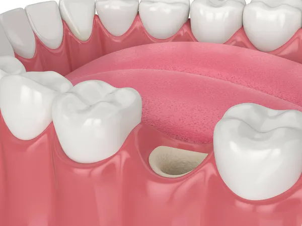 Comment se passe une greffe osseuse pour les dents ?
