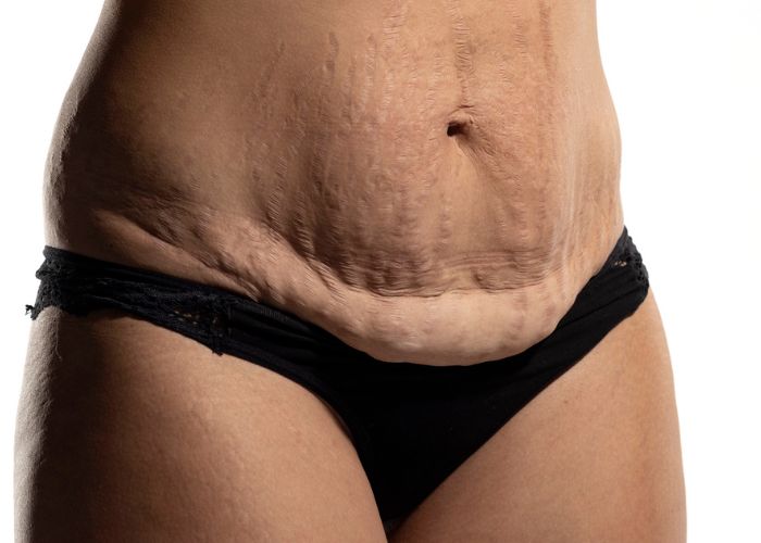 Comment se débarrasser de la peau affaissée après une perte de poids ?