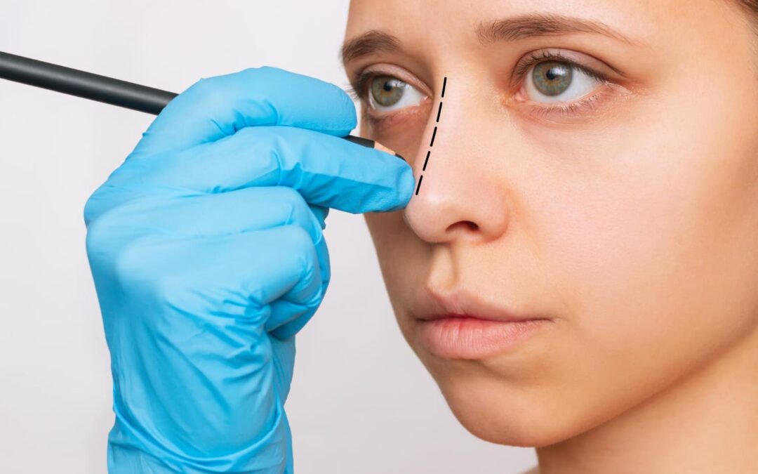 Est-ce que la pointe du nez redescend après une rhinoplastie ?