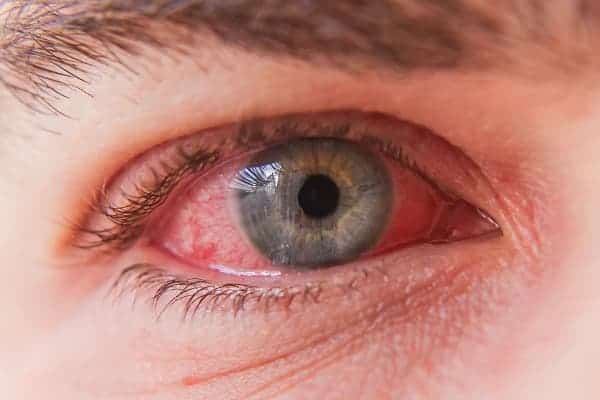 Est-il possible d’avoir un coup dans l’oeil après un LASIK ?