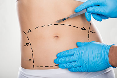 High Definition Abdominoplastie Tunisie : La chirurgie du ventre haute précision