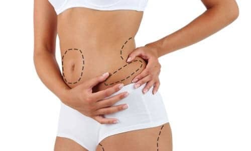 Quelle est la différence entre la liposuccion et le J-plasma ?