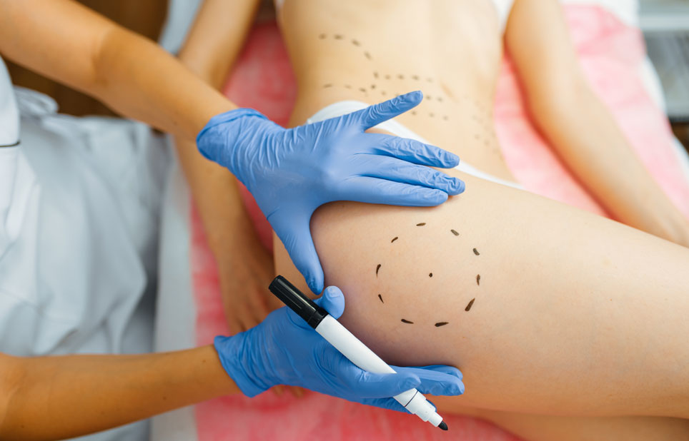 Traitement du Lipœdème par ArgoPlasma : Une Révolution Thérapeutique