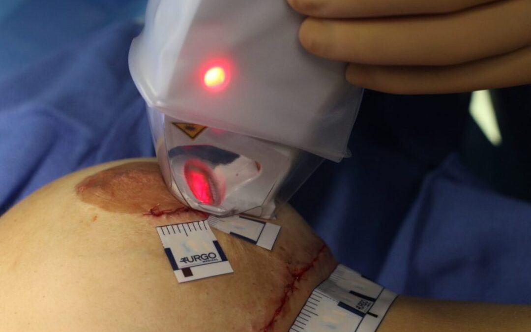 Urgo Touch Tunisie : Le laser pour améliorer les cicatrices