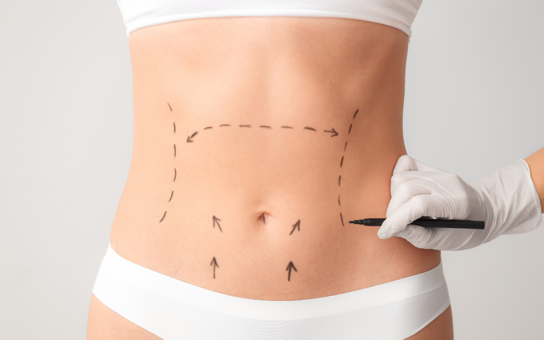 Abdominoplastie vs Techniques Non Invasives : Vibrofit, Quantum RF, Cryolipolyse