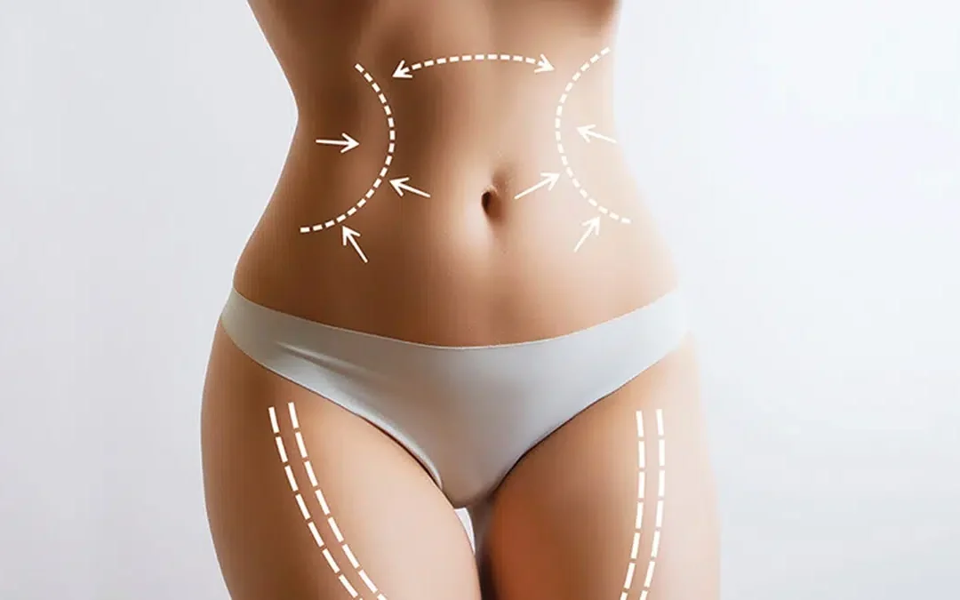 Argo Plasma, BodyTite et J-Plasma : Comparatif Complet des Technologies de Raffermissement Cutané