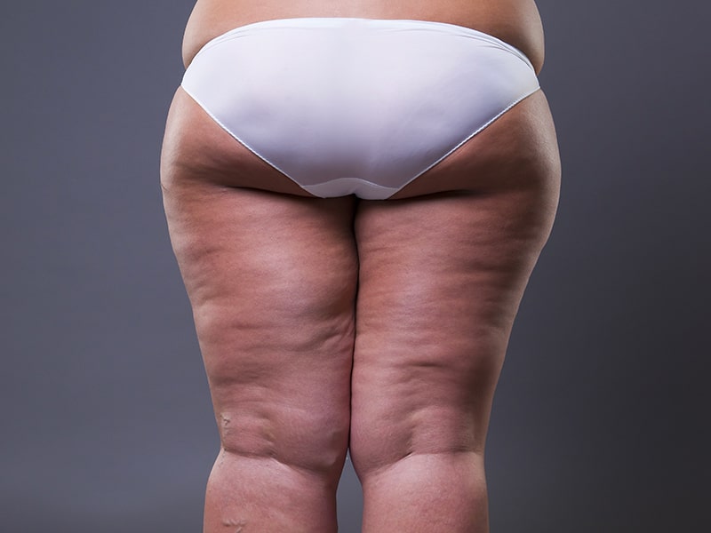 Chirurgie du Lipœdème en Tunisie : Guide Complet, Techniques et Résultats