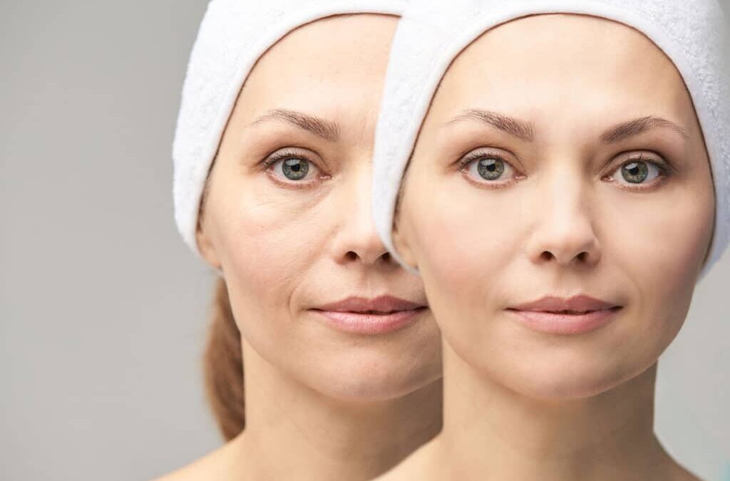 Comment puis-je combler les rides sans injection ?