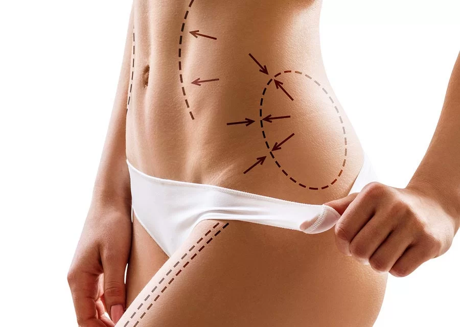 Liposuccion VASER et J-Plasma : la combinaison révolutionnaire pour une silhouette sculptée et une peau raffermie