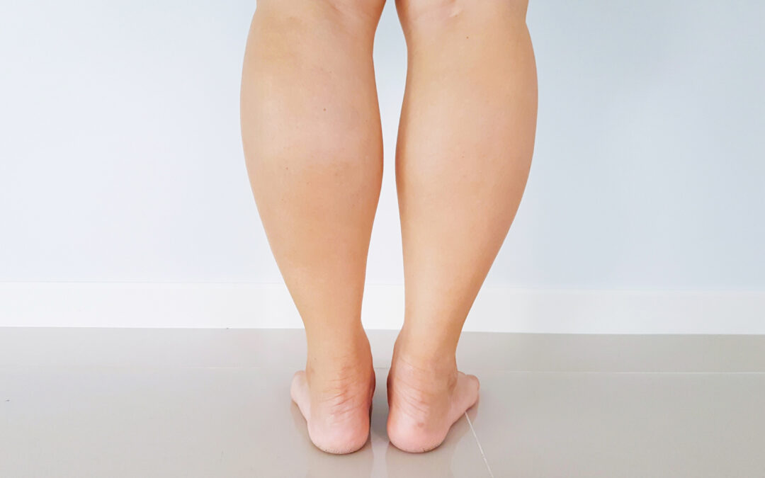 Liposuccion des mollets : La quête esthétique des jambes affinées