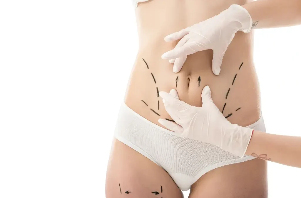 Liposuccion abdominale + BodyTite : ventre plat et peau raffermie sans cicatrice