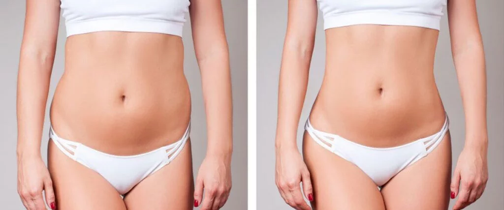 BodyTite et FaceTite : nouvelle ère du raffermissement cutané sans chirurgie lourde