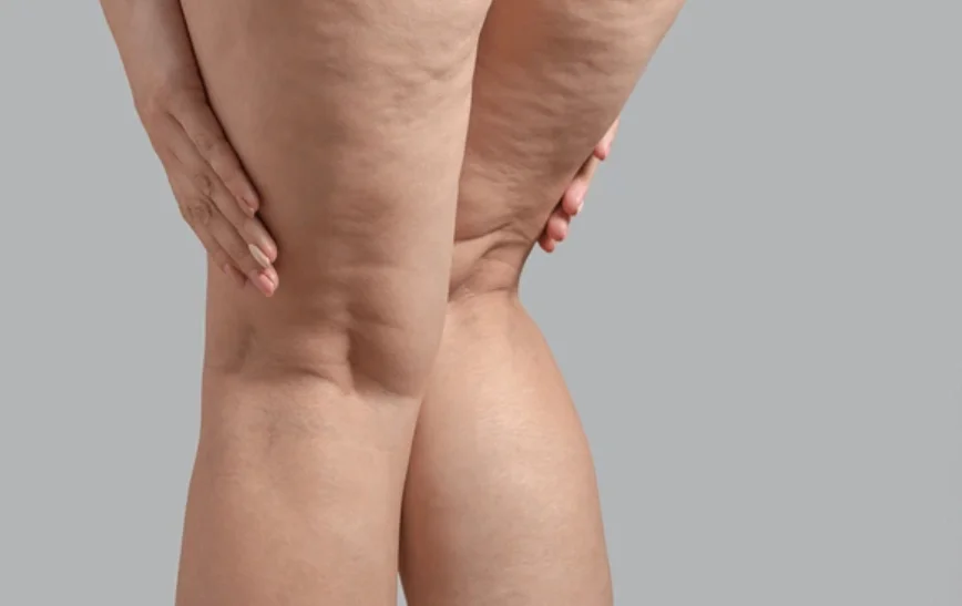 La liposuccion WAL est-elle efficace pour le lipœdème sévère ?