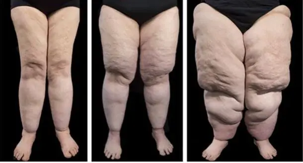 Quelles différences entre lymphœdème, lipœdème et lipolymphœdème ?