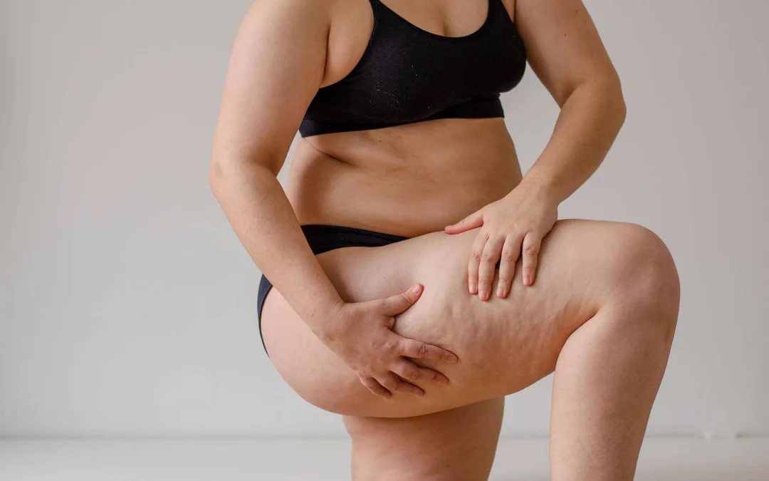 Dr Ramy Ben Salah, référence en lipoedème sévère : Symptômes, Causes et Solutions