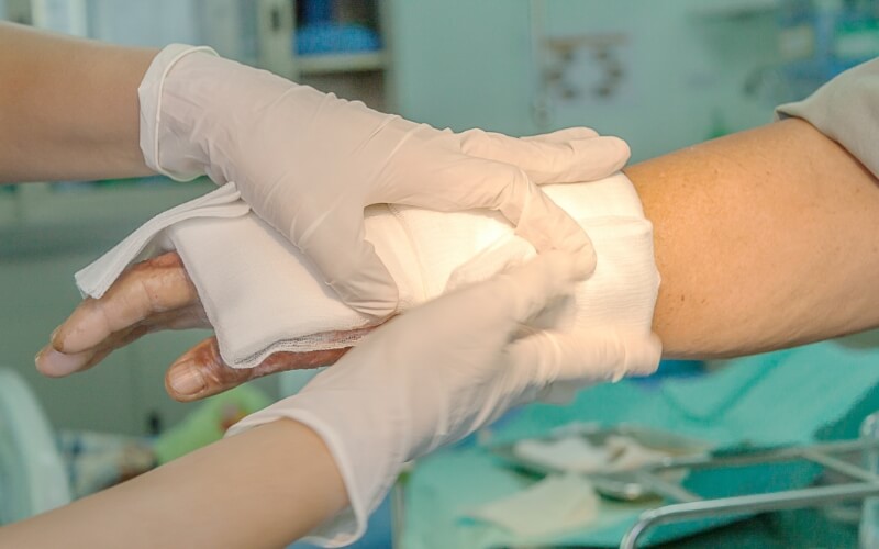 Traitement des brûlures graves grâce au derme artificiel avec le Dr Ramy Ben Salah