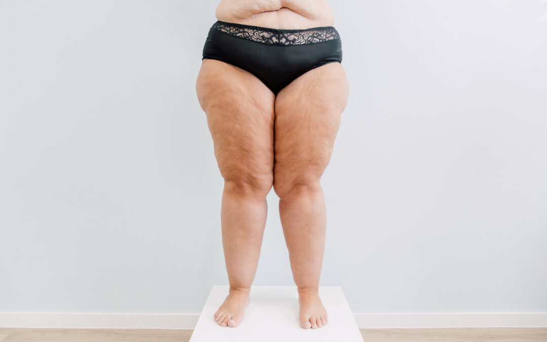 Traitement du lipœdème : Méthodes avancées et prise en charge globale