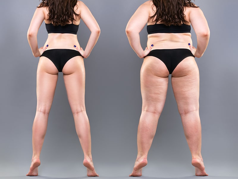 Lipœdème et lipo-lymphœdème : stades, progression et prise en charge