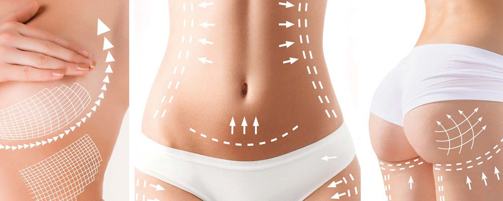 Lipœdème et liposuccion haute définition : est-ce une option thérapeutique ?