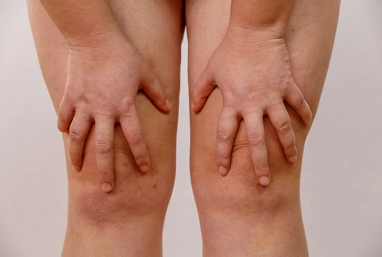 Lipœdème : qu’est-ce que cette maladie chronique souvent confondue avec l’obésité ?