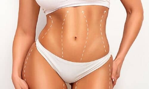 Liposuccion HD avec Renuvion ou J-Plasma : raffermissement simultané de la peau