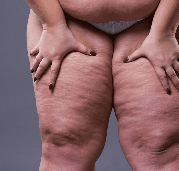 Liposuccion du lipœdème : différences entre WAL, PAL et technique tumescente