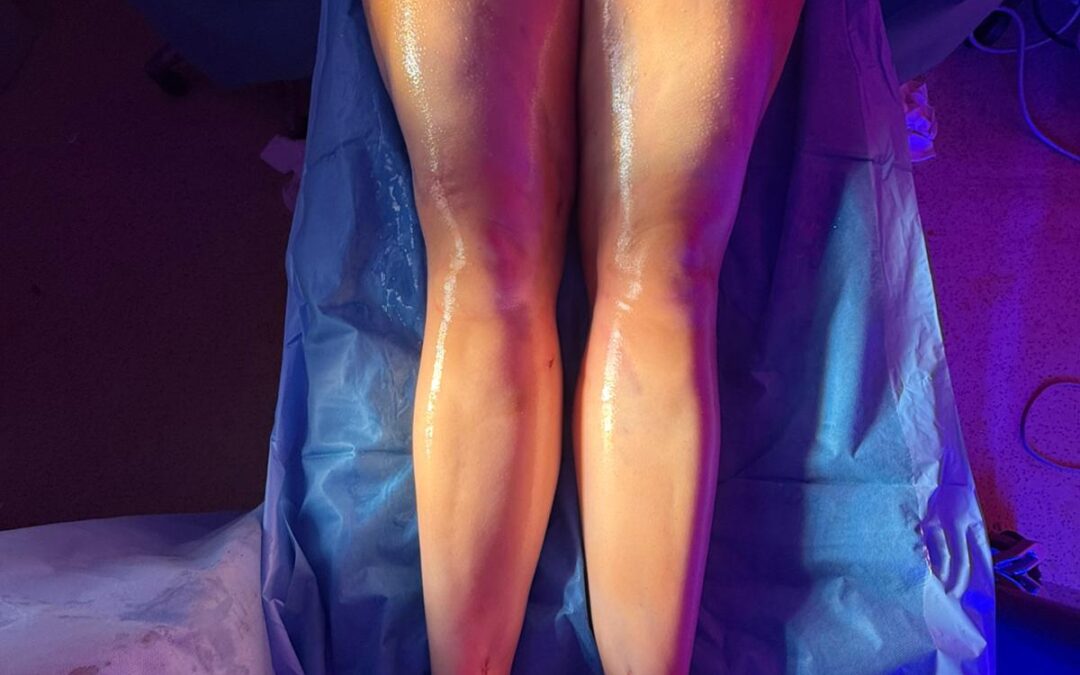 4D lipo et lipœdème : ce que disent les recommandations médicales